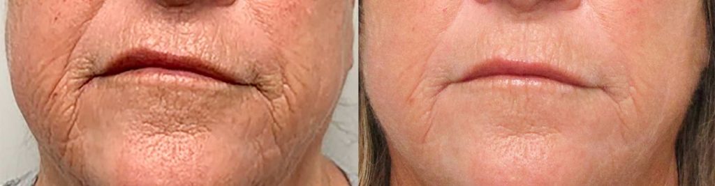 Vorher-Nachher-Ergebnis einer Laserbehandlung zur Hautverjüngung in der Noris Dermatologie Nürnberg